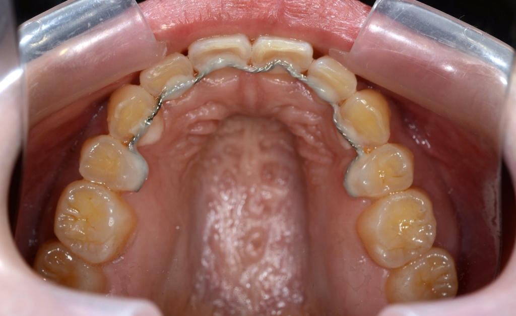 出っ歯でガミースマイルの矯正後の歯並び