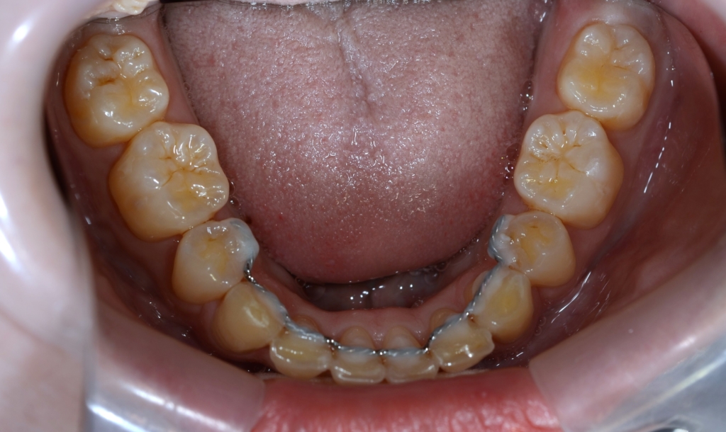 出っ歯でガミースマイルの矯正後の歯並び
