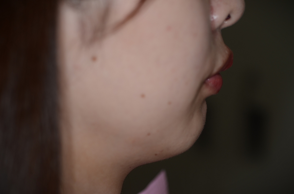 出っ歯でガミースマイルの矯正後の横顔と口元