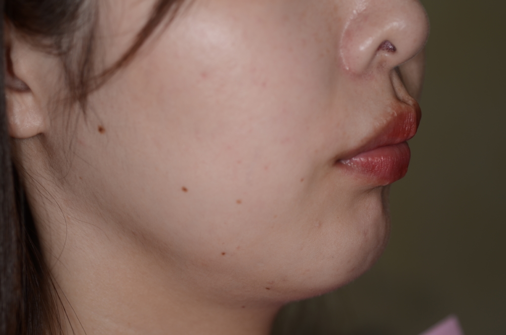 出っ歯でガミースマイルの矯正後の横顔と口元