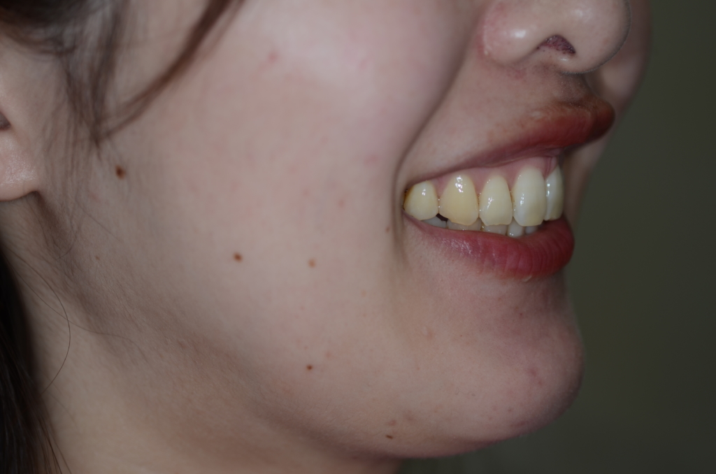 出っ歯でガミースマイルの矯正後の笑顔の横顔と口元