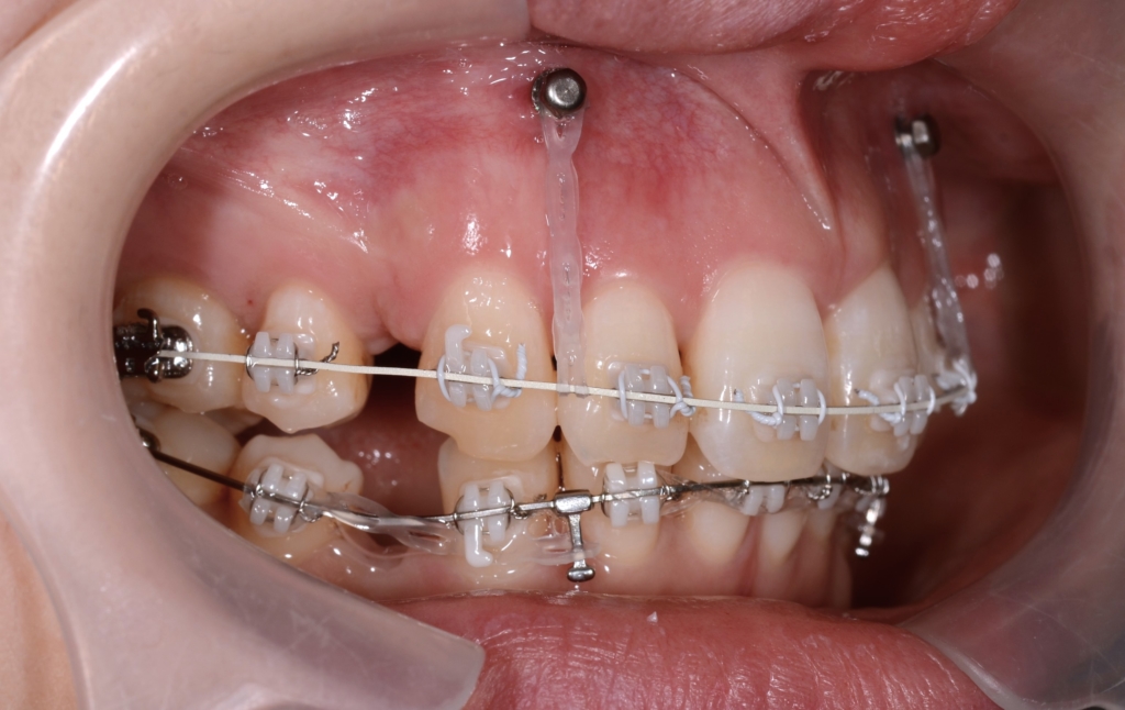 アンカースクリューを併用した矯正治療
