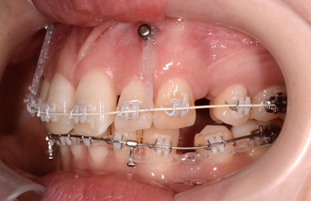 アンカースクリューを併用した矯正治療