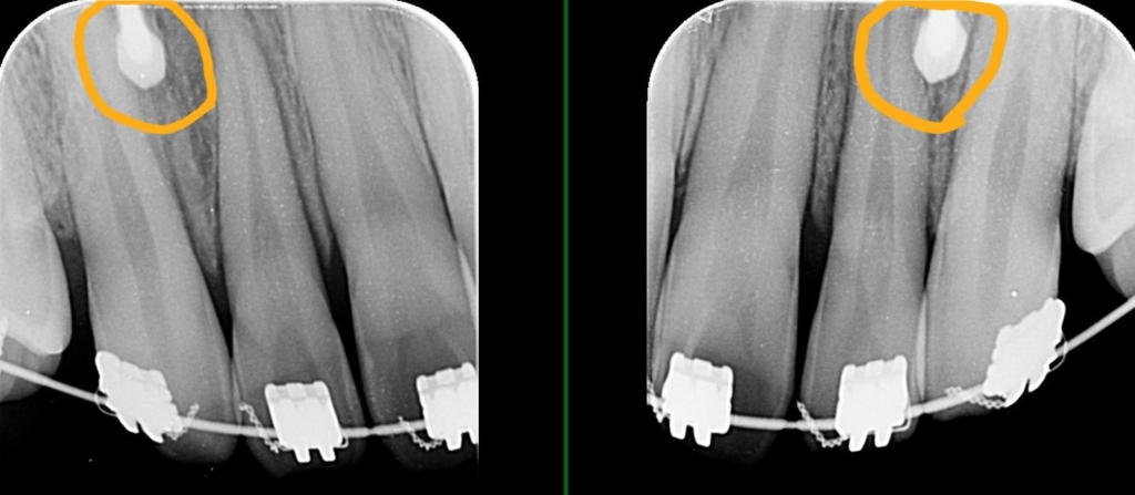 上顎の前歯部にアンカースクリューを植立
