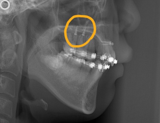 上顎の口蓋部にアンカースクリューを植立