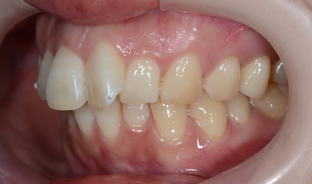 出っ歯でガミースマイルの矯正前の歯並び