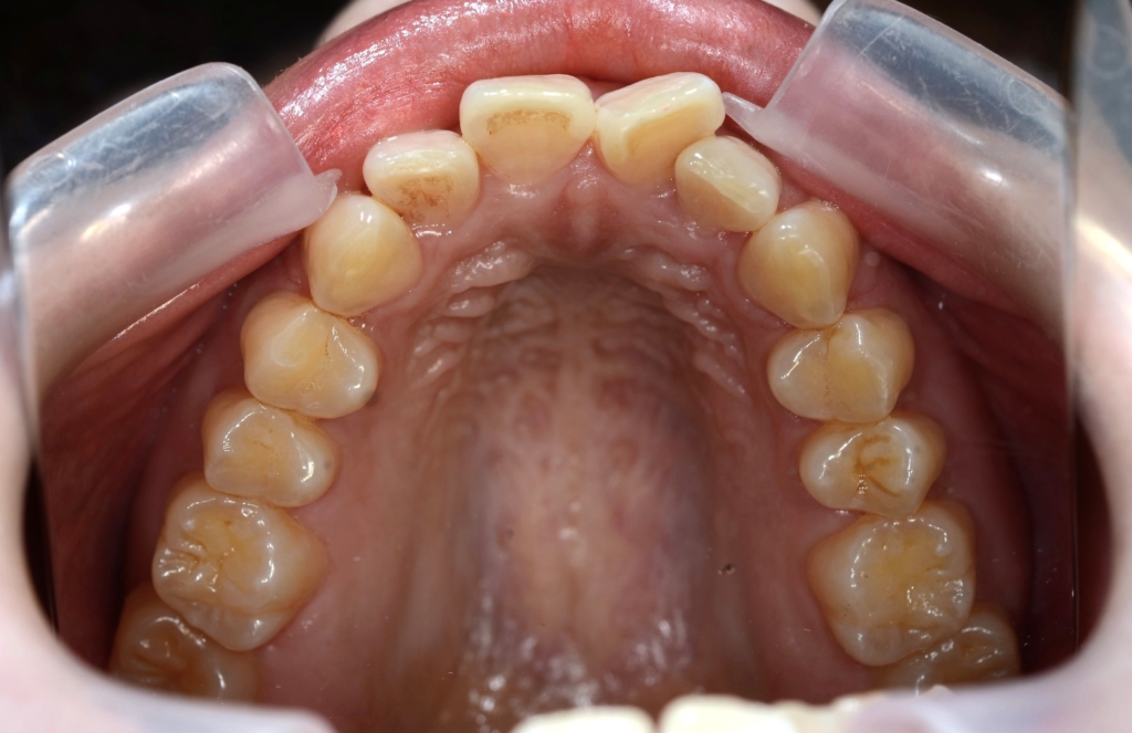 出っ歯でガミースマイルの矯正前の歯並び