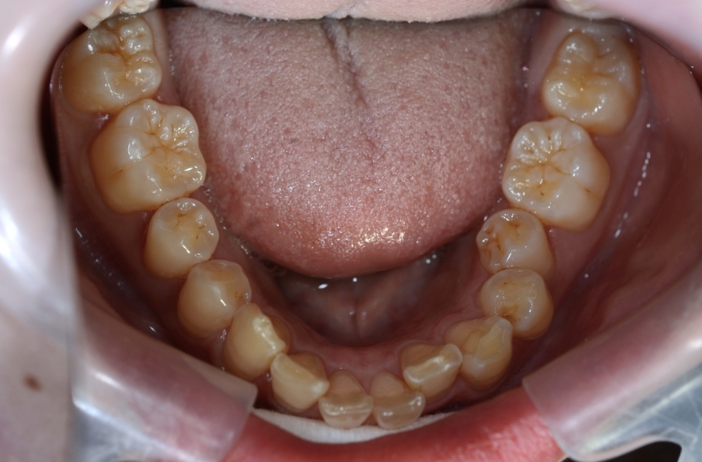 出っ歯でガミースマイルの矯正前の歯並び