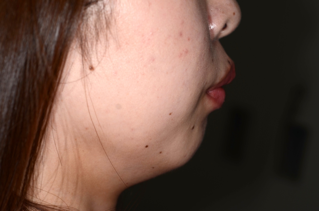 出っ歯でガミースマイルの矯正前の横顔と口元