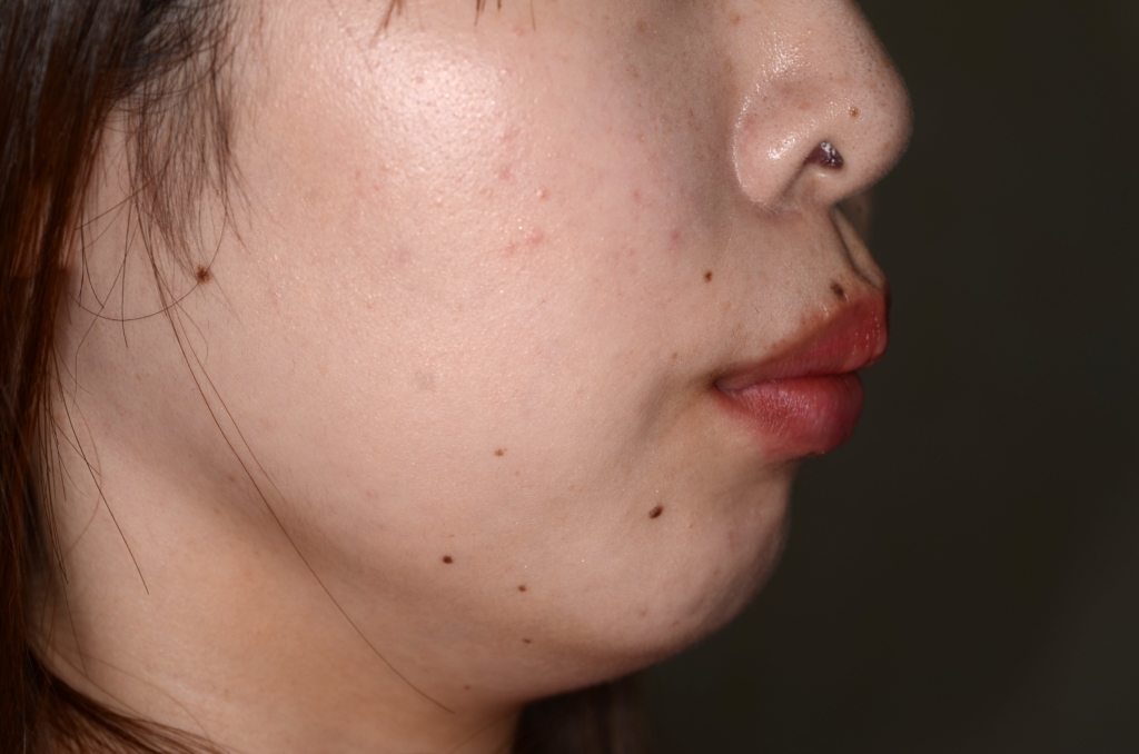 出っ歯でガミースマイルの矯正前の横顔と口元