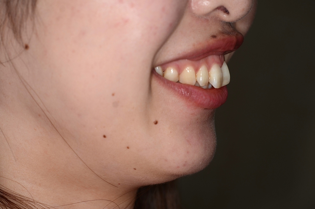 出っ歯でガミースマイルの矯正前の笑顔の横顔と口元