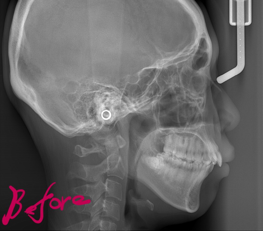 出っ歯でガミースマイルの矯正前の頭部を横から見たレントゲン写真