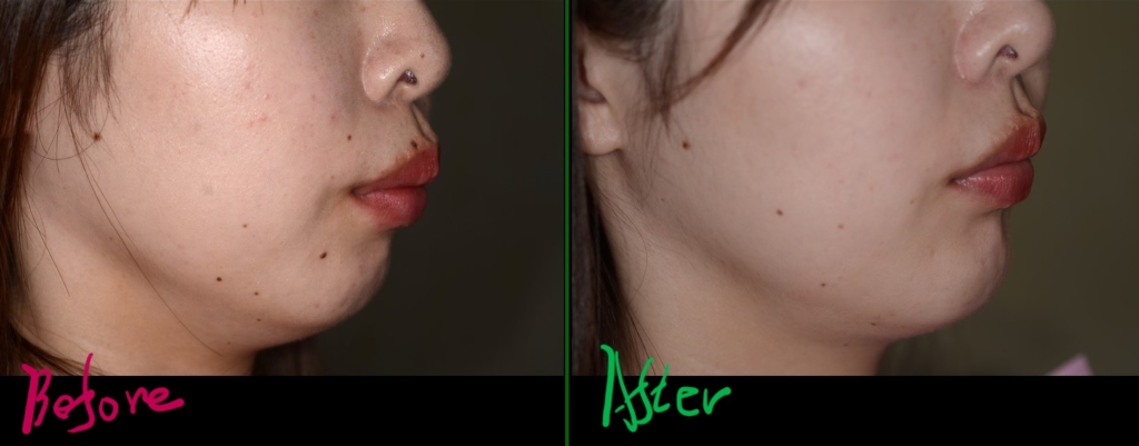 出っ歯でガミースマイルを矯正した治療前後の横顔と口元の変化の比較