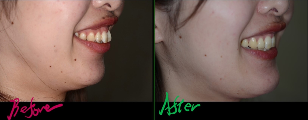 出っ歯でガミースマイルを矯正した治療前後の笑顔の横顔と口元の変化の比較