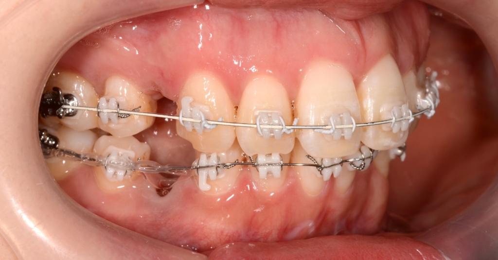 マルチブラケットシステムで矯正治療開始（白いワイヤーを使用）