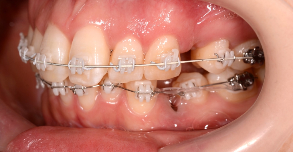 マルチブラケットシステムで矯正治療開始（白いワイヤーを使用）