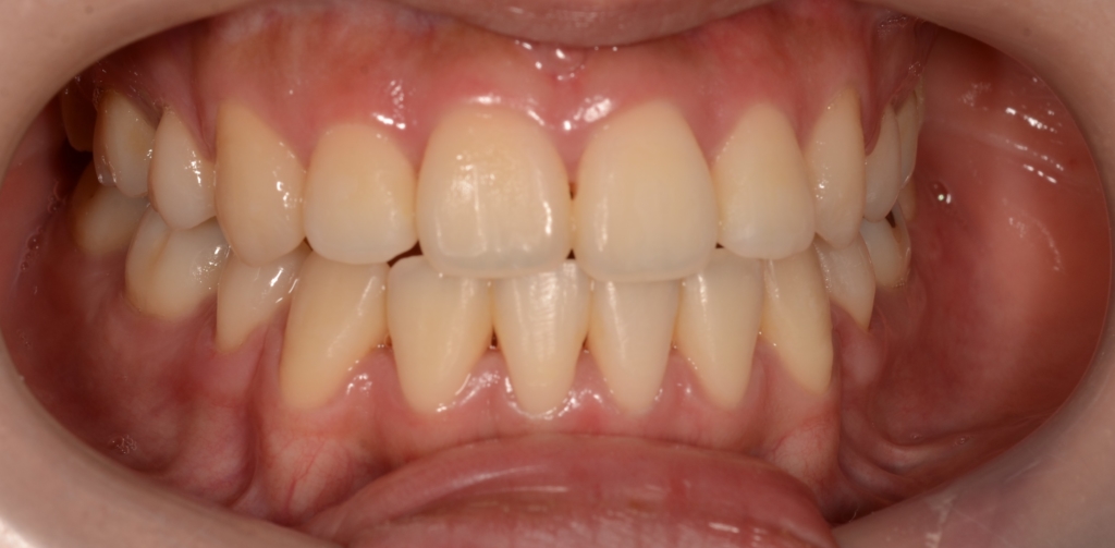 ごぼ口を矯正治療した後の歯並び