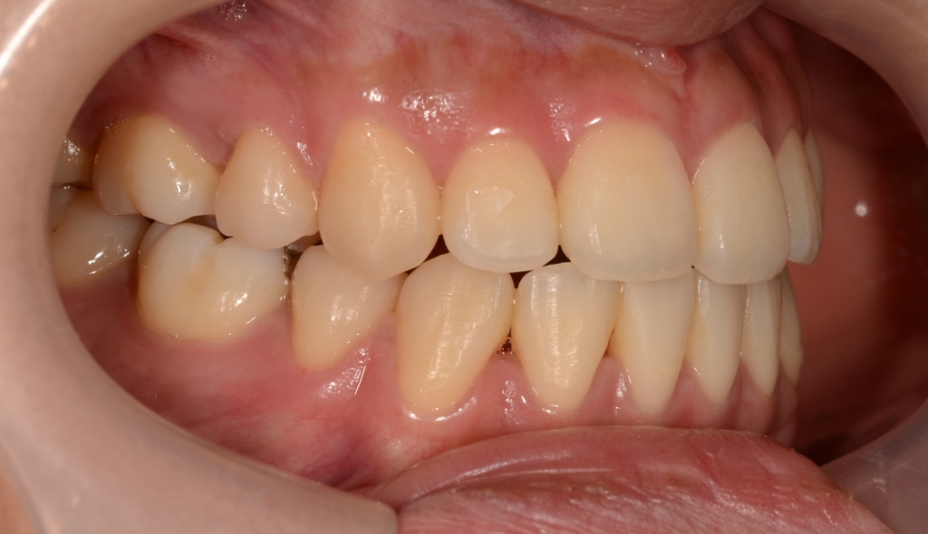 ごぼ口を矯正治療した後の歯並び