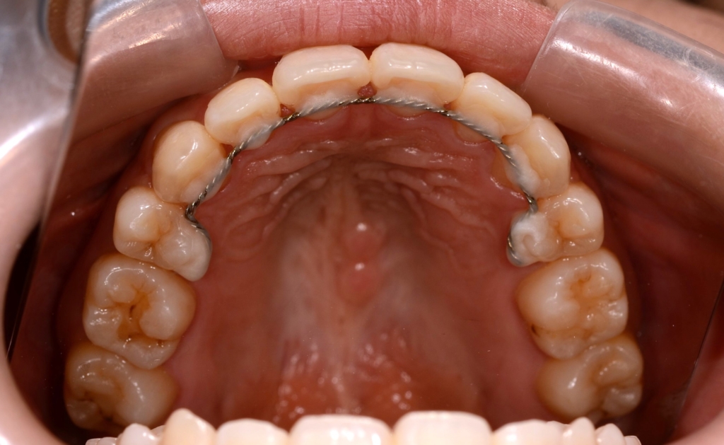 ごぼ口を矯正治療した後の歯並び