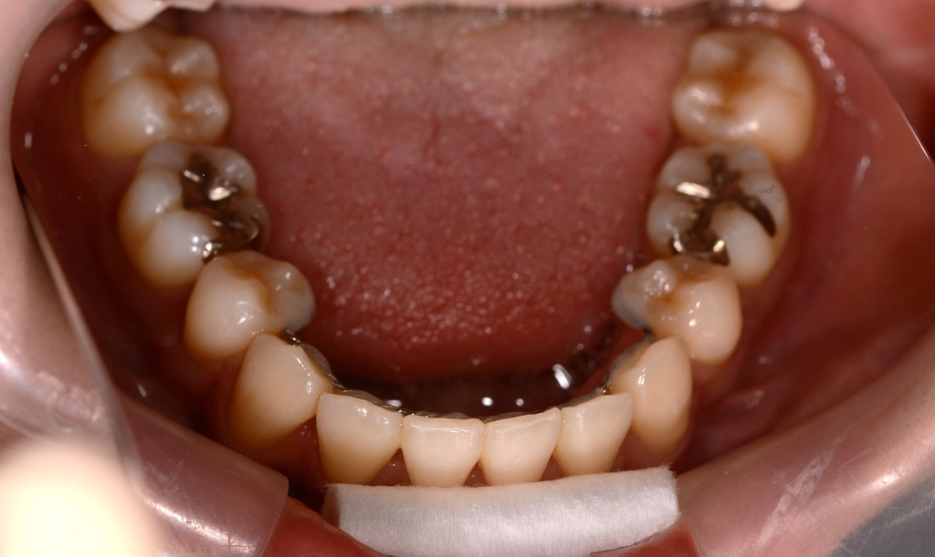 ごぼ口を矯正治療した後の歯並び