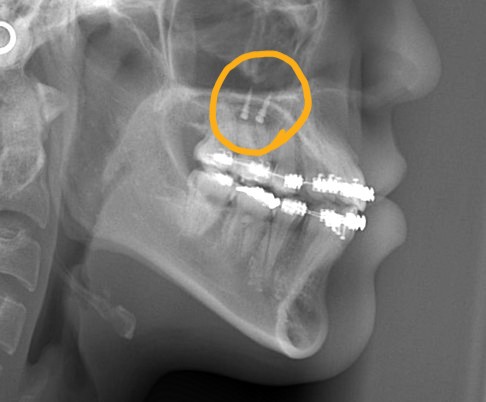 上顎の口蓋にアンカースクリューを植立