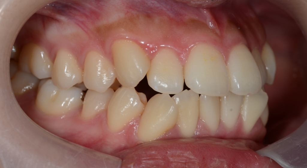 ごぼ口を矯正治療する前の歯並び