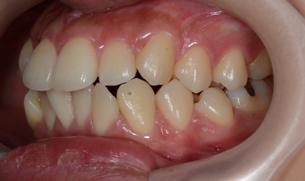 ごぼ口を矯正治療する前の歯並び