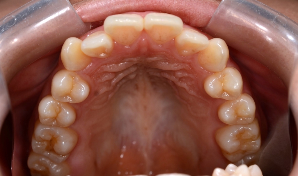 ごぼ口を矯正治療する前の歯並び