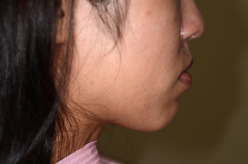 ごぼ口を矯正治療する前の横顔と口元