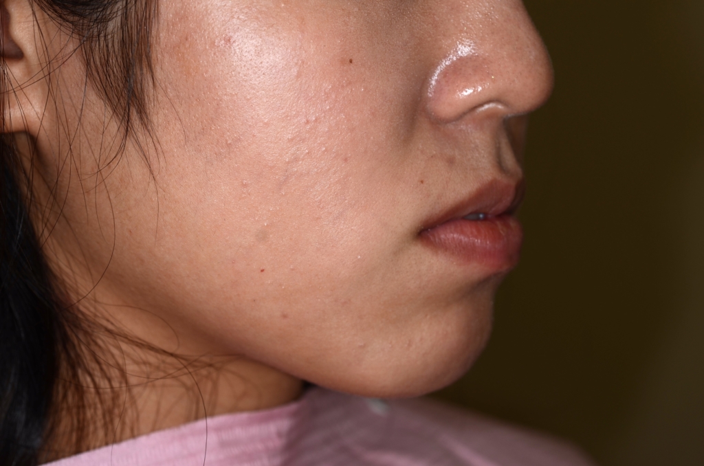 ごぼ口を矯正治療する前の横顔と口元