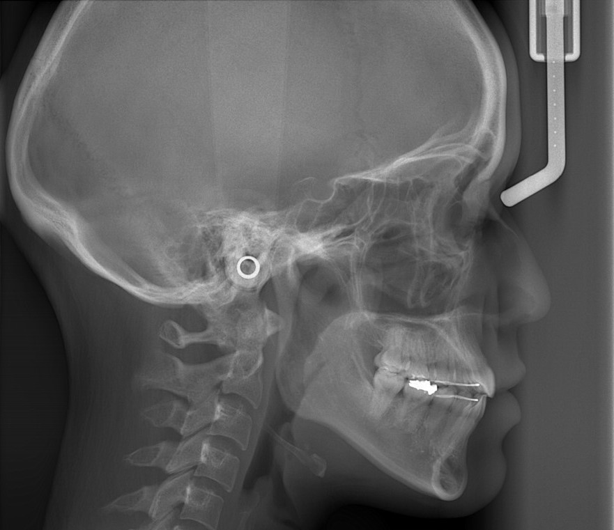 口ゴボの矯正後の頭部を横から見たレントゲン写真