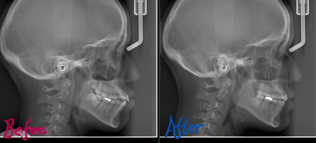 口ゴボを矯正した治療前後のレントゲン写真による比較