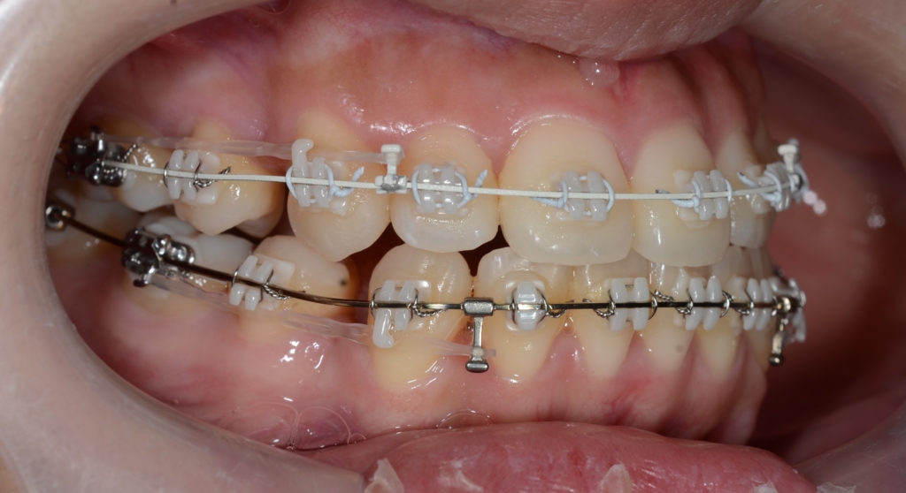 マルチブラケットシステム(白いワイヤー使用)で矯正治療中