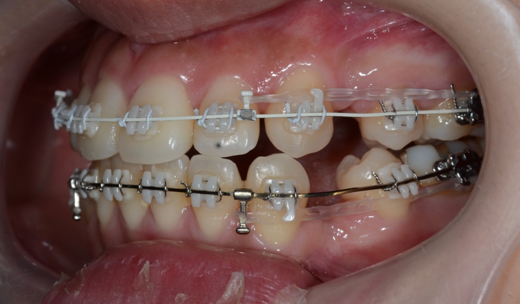 マルチブラケットシステム(白いワイヤー使用)で矯正治療中