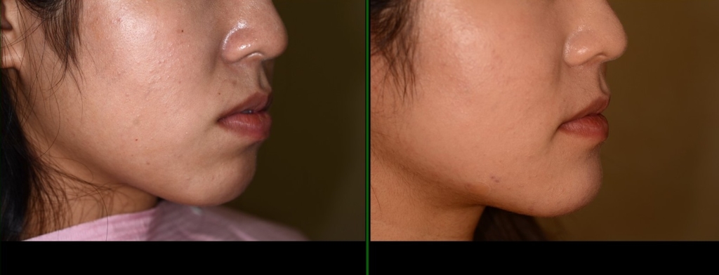 ごぼ口を矯正した治療前後の横顔と口元の比較