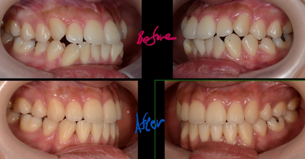 ごぼ口を矯正した治療前後の歯並びの比較