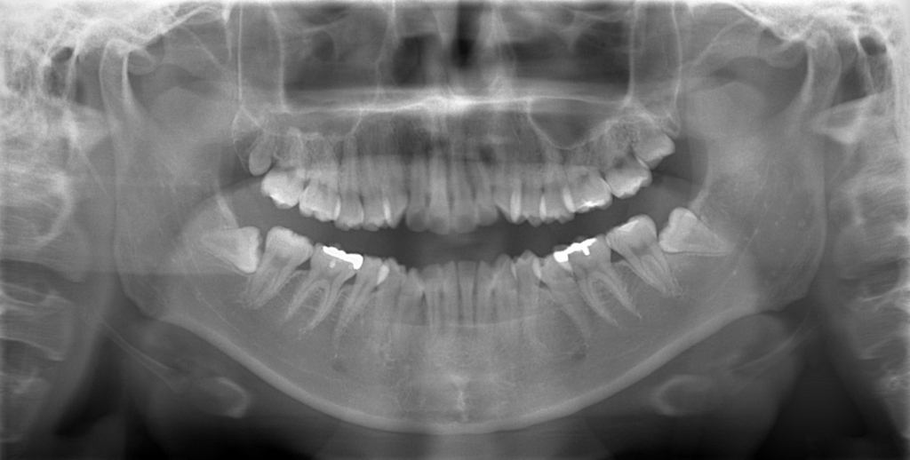 口ゴボの矯正前の顎全体のレントゲン写真