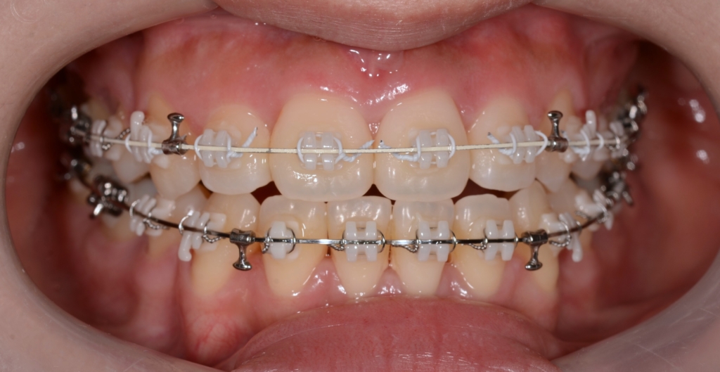 上下の正中のズレをアンカースクリューに付けたPLASを用いて修正
