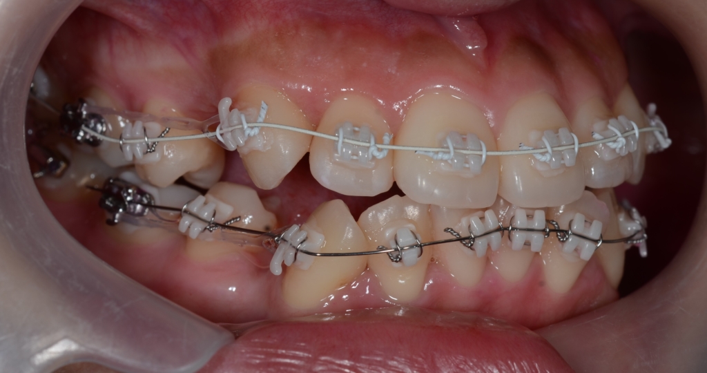 マルチブラケットシステム(白いワイヤー使用)で矯正治療開始