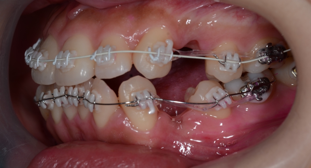 マルチブラケットシステム(白いワイヤー使用)で矯正治療開始