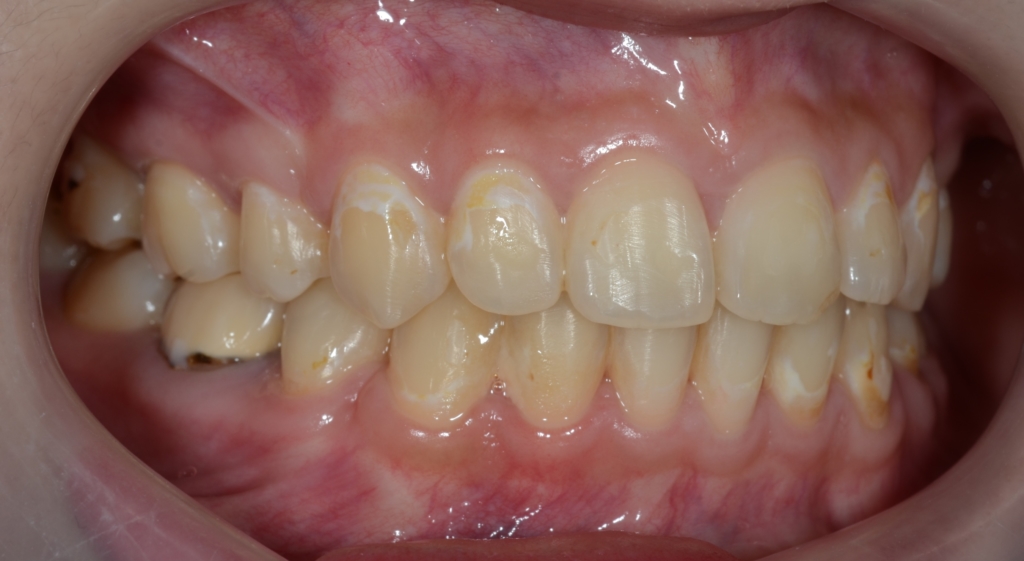 口ゴボを矯正治療した後の歯並び