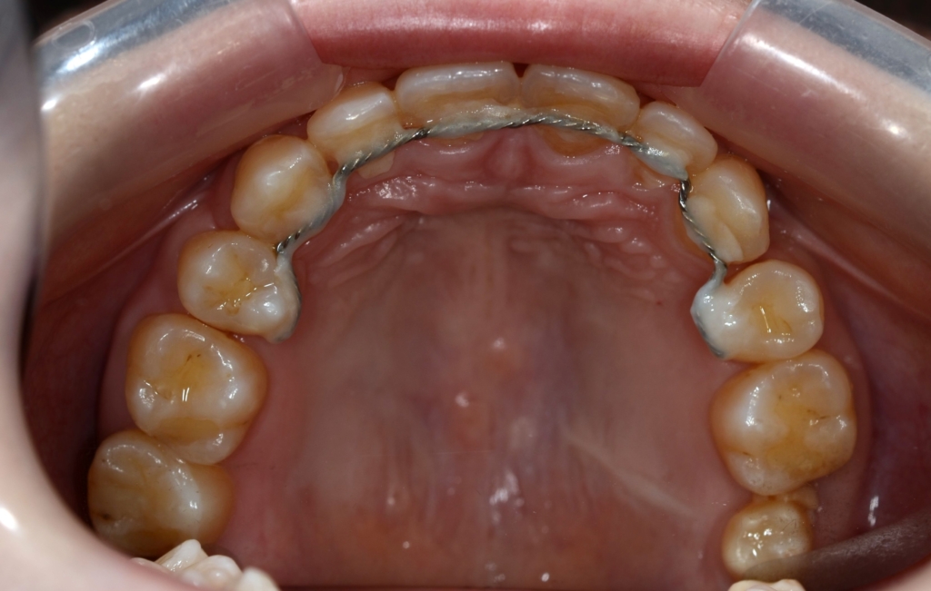 口ゴボを矯正治療した後の歯並び