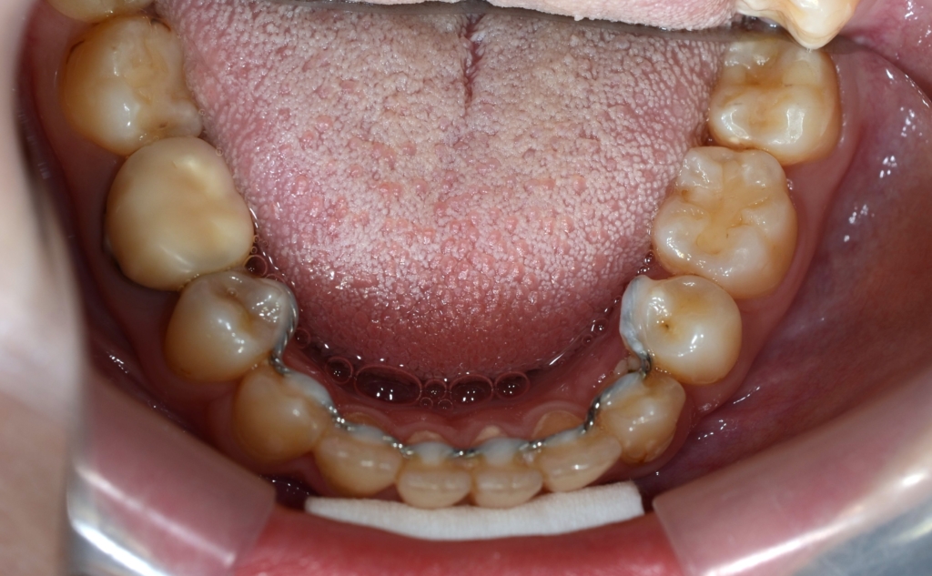 口ゴボを矯正治療した後の歯並び