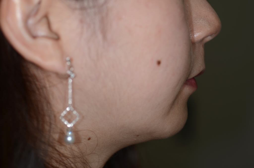 口ゴボを矯正治療した後の横顔と口元