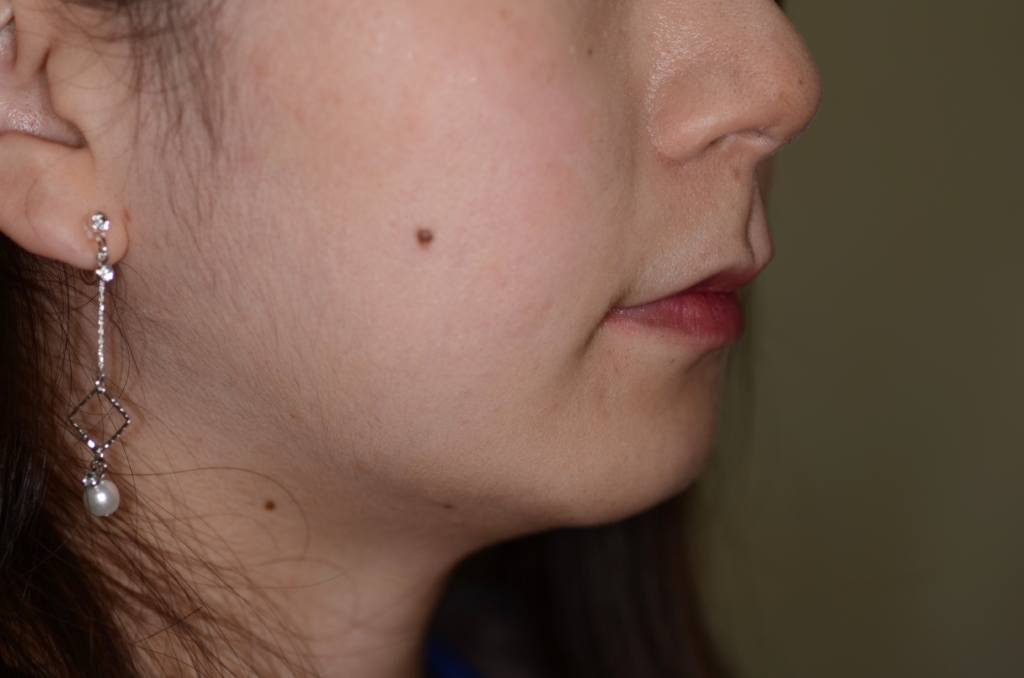 口ゴボを矯正治療した後の横顔と口元