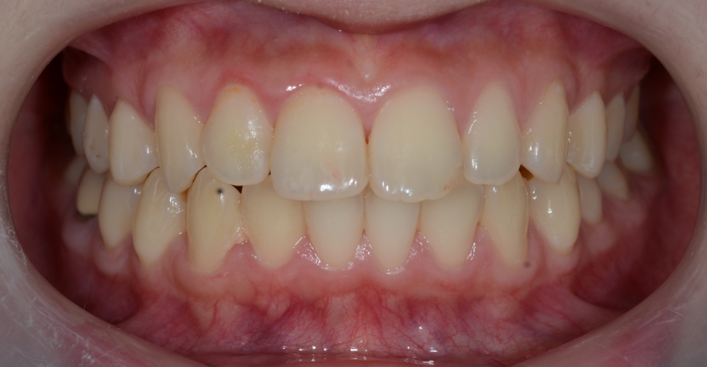 口ゴボを矯正治療する前の歯並び