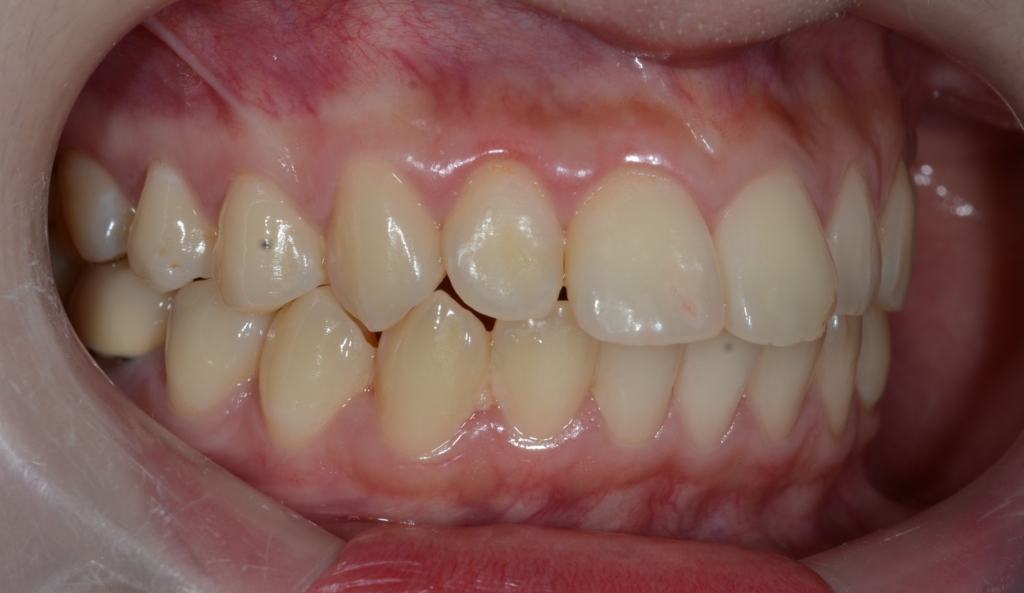 口ゴボを矯正治療する前の歯並び