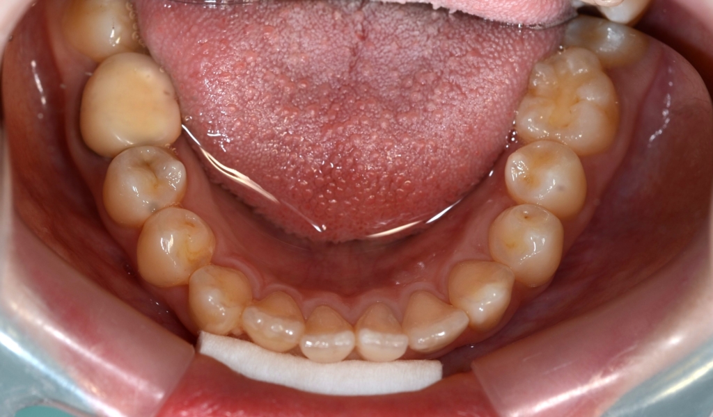 口ゴボを矯正治療する前の歯並び