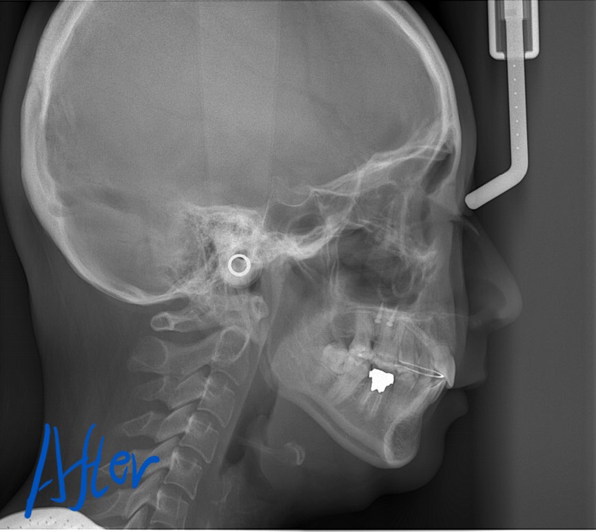 ゴボ口の矯正後の頭部を横から見たレントゲン写真