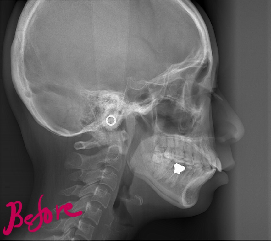 ゴボ口の矯正前の頭部を横から見たレントゲン写真